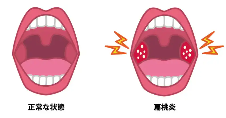 扁桃炎